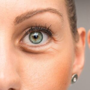 Unterlidstraffung (Tränensäcke OP) Eyelid Aesthetics Frankfurt, PD Dr. Simon DUlz